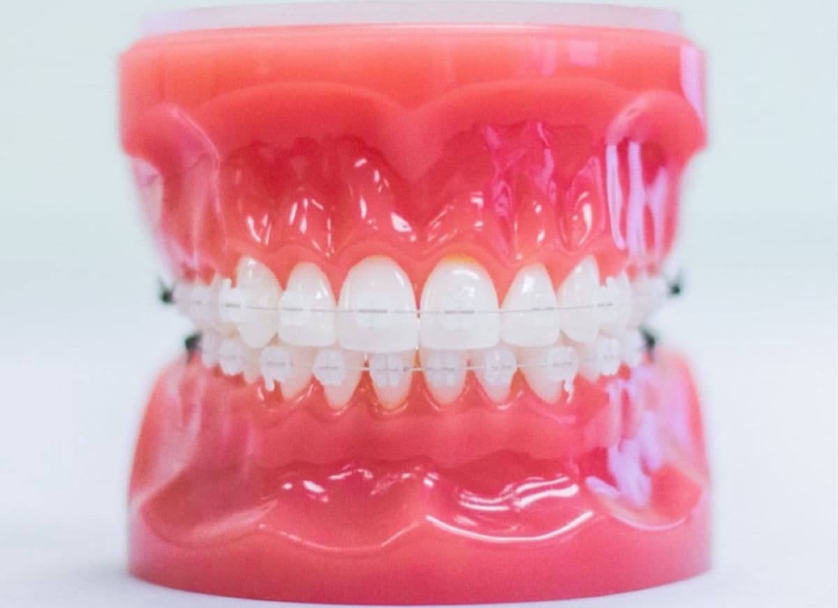 clear braces on plastic model