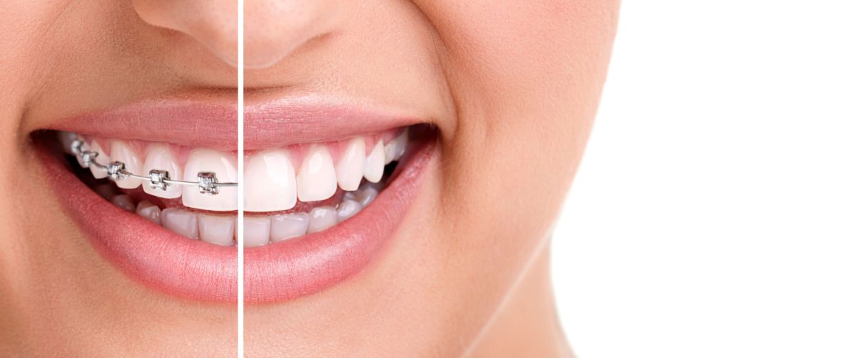 Braces Vs. Invisalign: Which One Is Right For You?