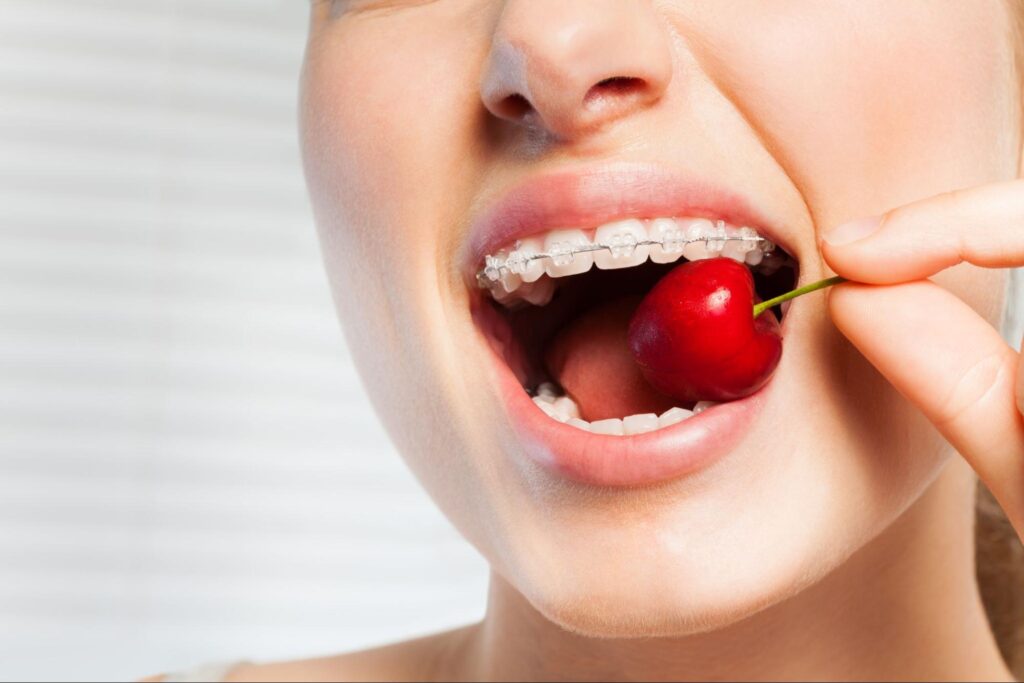 Eating with Braces: Recipes and Grocery Tips